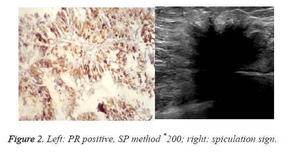 biomedres-spiculation-sign