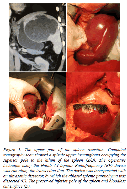 biomedres-spleen-resection