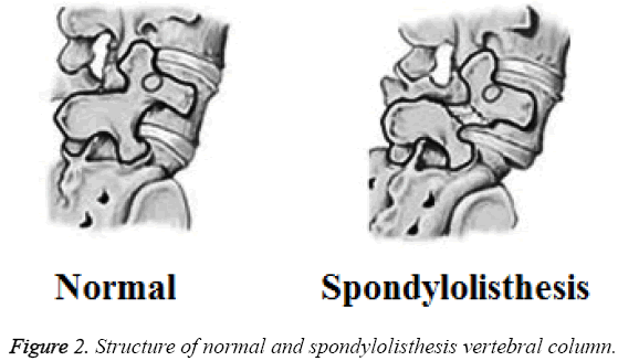 biomedres-spondylolisthesis-vertebral-column