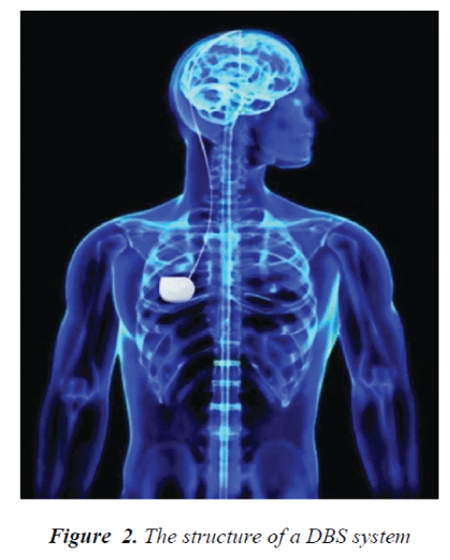 biomedres-structure-DBS-system