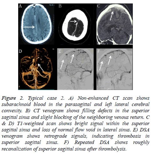 biomedres-subarachnoid-blood