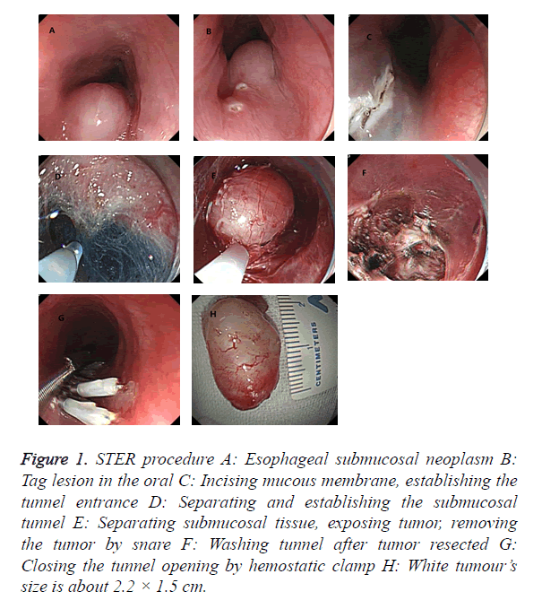 biomedres-submucosal-neoplasm