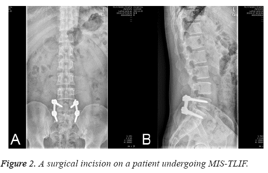 biomedres-surgical-incision-patient