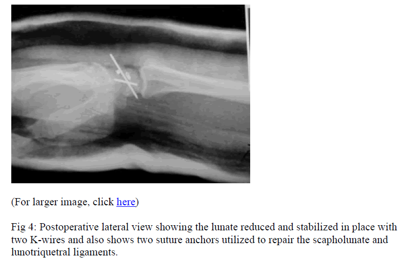 biomedres-suture-anchors-utilized