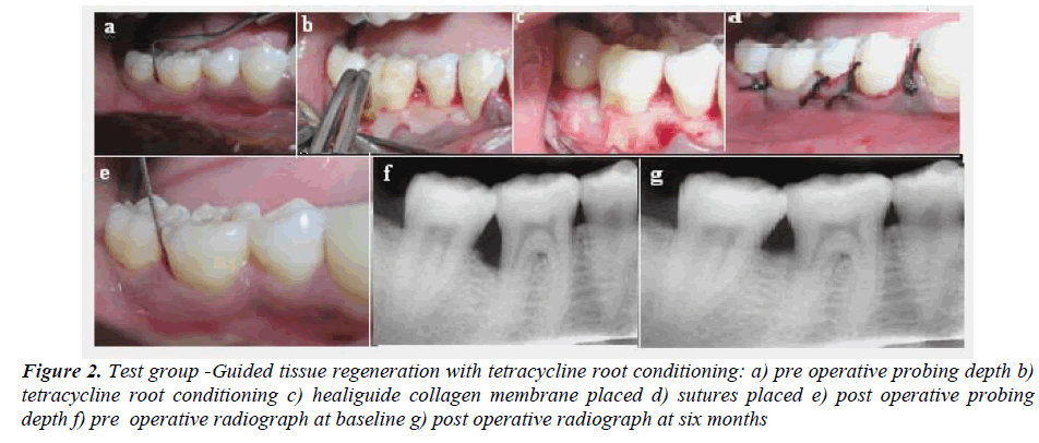 biomedres-tetracycline-root-conditioning