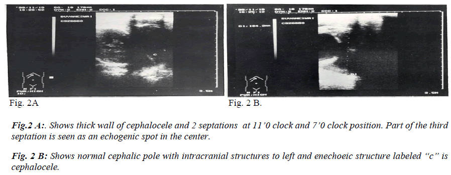 biomedres-thick-wall-cephalocele