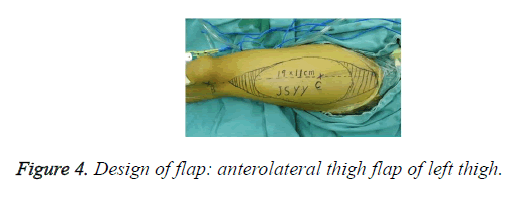 biomedres-thigh-flap