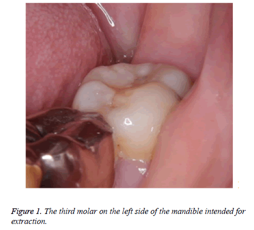 biomedres-third-molar