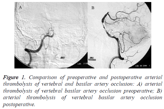 biomedres-thrombolysis-occlusion