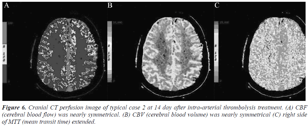 biomedres-thrombolysis-treatment