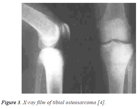 biomedres-tibial-osteosarcoma