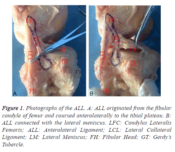 biomedres-tibial-plateau