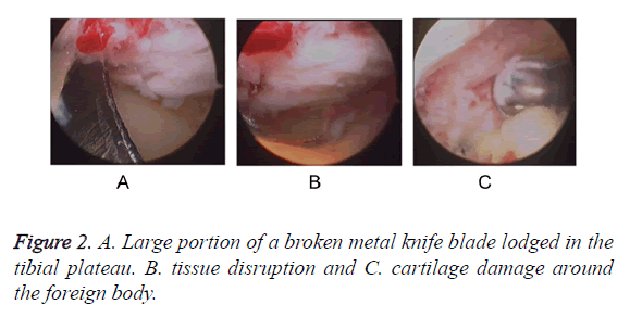 biomedres-tibial-plateau