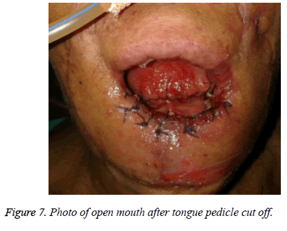 biomedres-tongue-pedicle