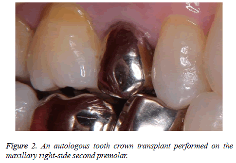 biomedres-tooth-crown