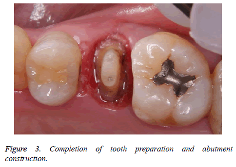 biomedres-tooth-preparation