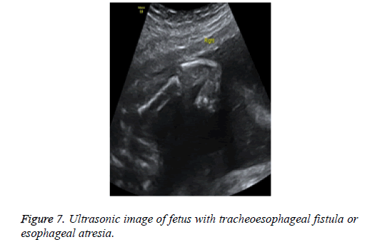 biomedres-tracheoesophageal-fistula