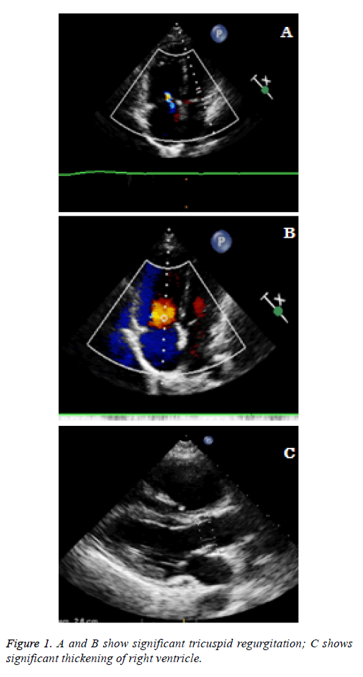 biomedres-tricuspid-regurgitation