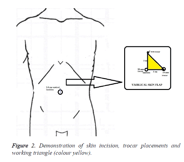 biomedres-trocar-placements