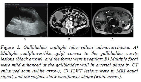 biomedres-tube-villous