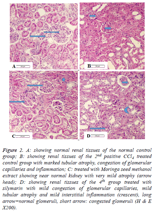 biomedres-tubular-atrophy