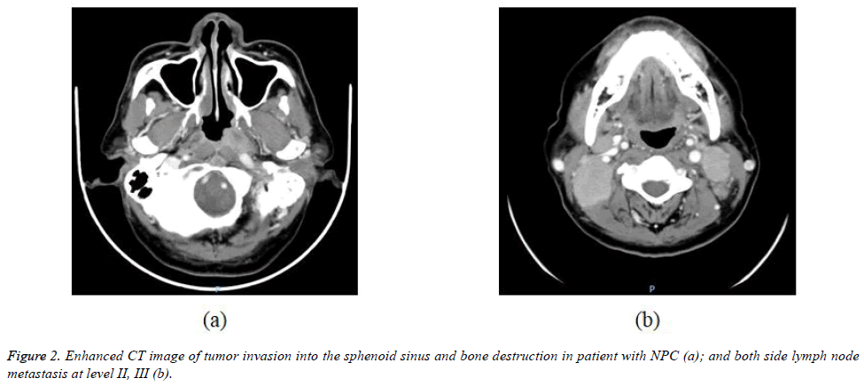 biomedres-tumor-invasion