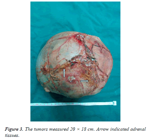 biomedres-tumors-measured