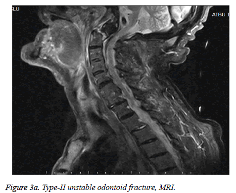 biomedres-unstable-odontoid