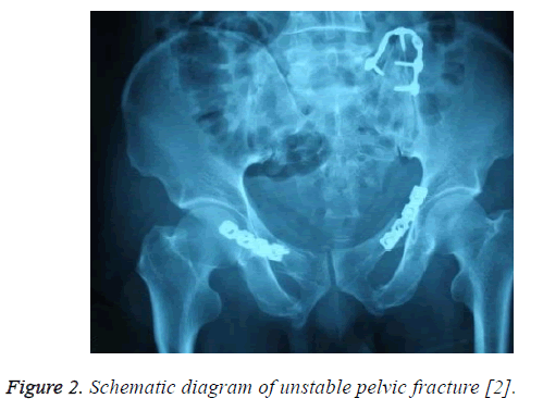 biomedres-unstable-pelvic-fracture