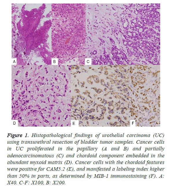 biomedres-urothelial-carcinoma