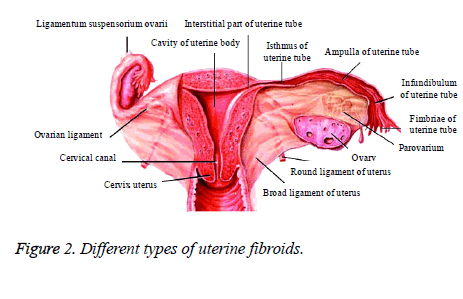 biomedres-uterine-fibroids