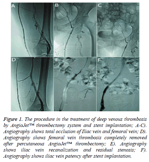 biomedres-venous-thrombosis