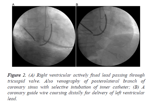 biomedres-ventricular-actively