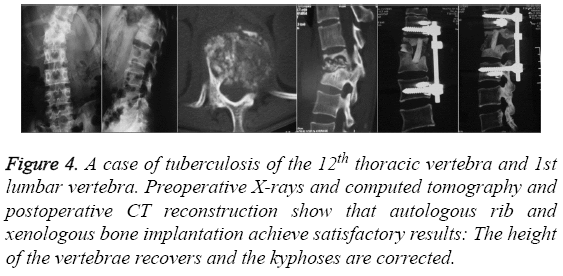 biomedres-vertebrae-recovers-kyphoses