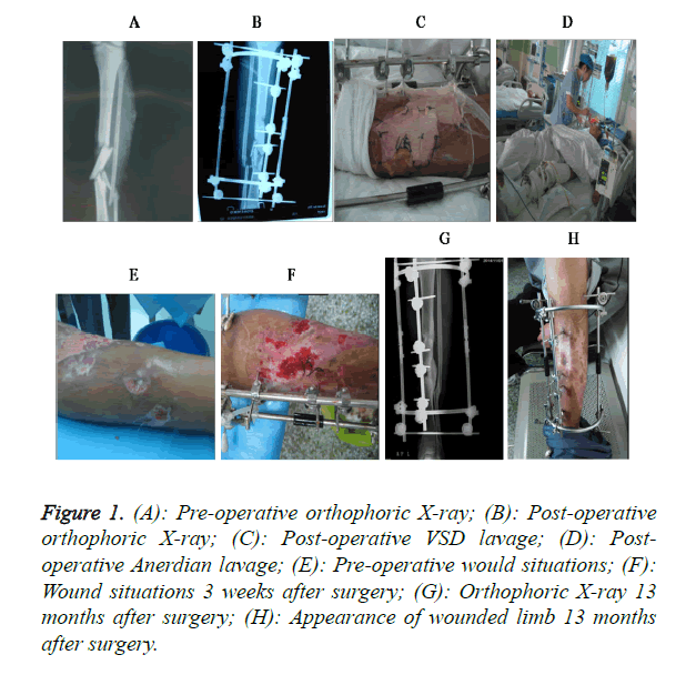 biomedres-wounded-limb